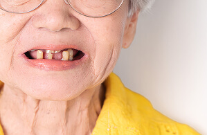 缺牙影響生活